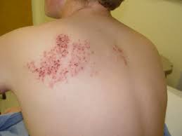 shingles1