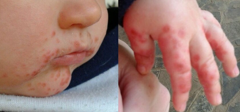 hand foot and mouth disease